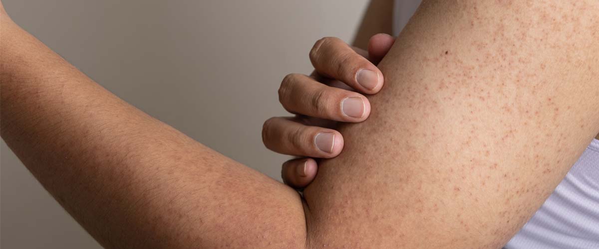 can glutathione help keratosis pilaris Keratosis Pilaris Treatment: From Creams to Lasers main image 1