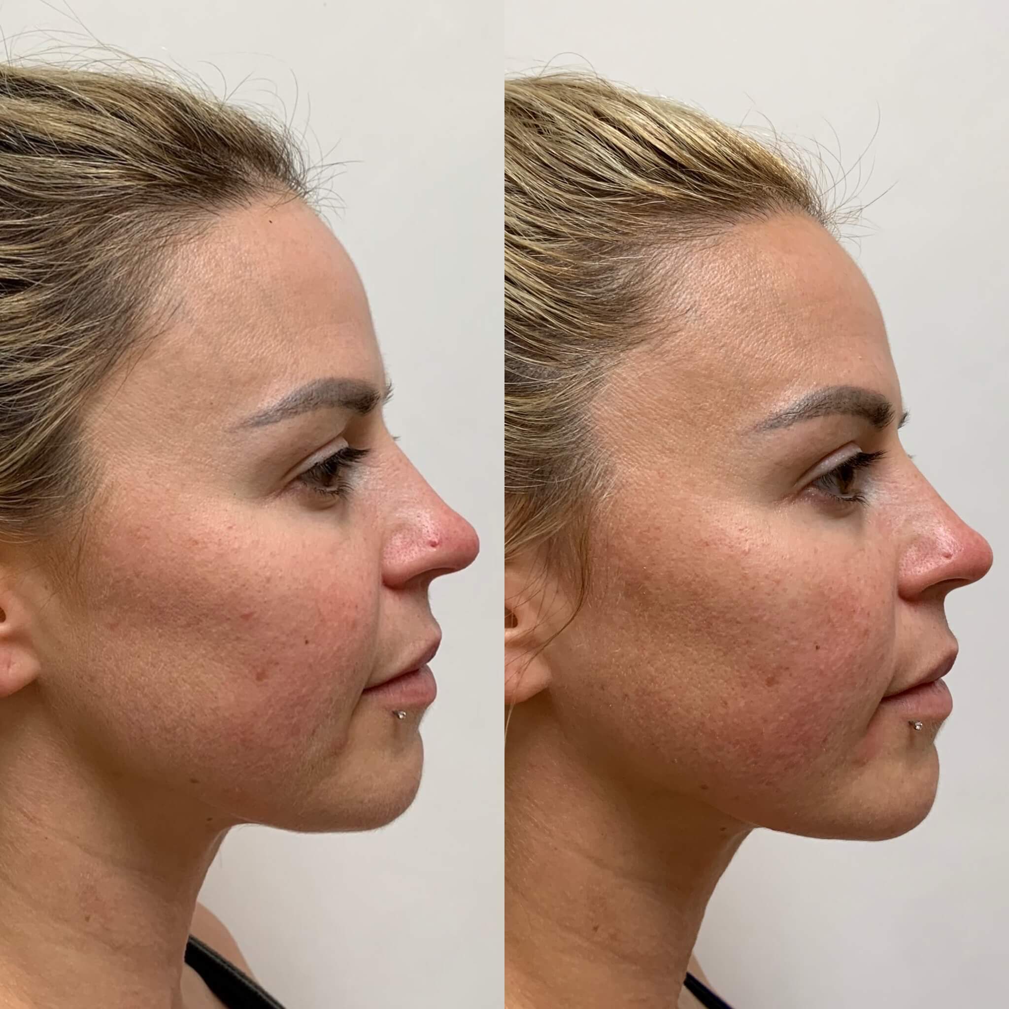 beauty-boost-threadlift-treatments-before-after-carousel-thirtyone beauty-boost-threadlift-treatments-before-after-carousel-thirtyone