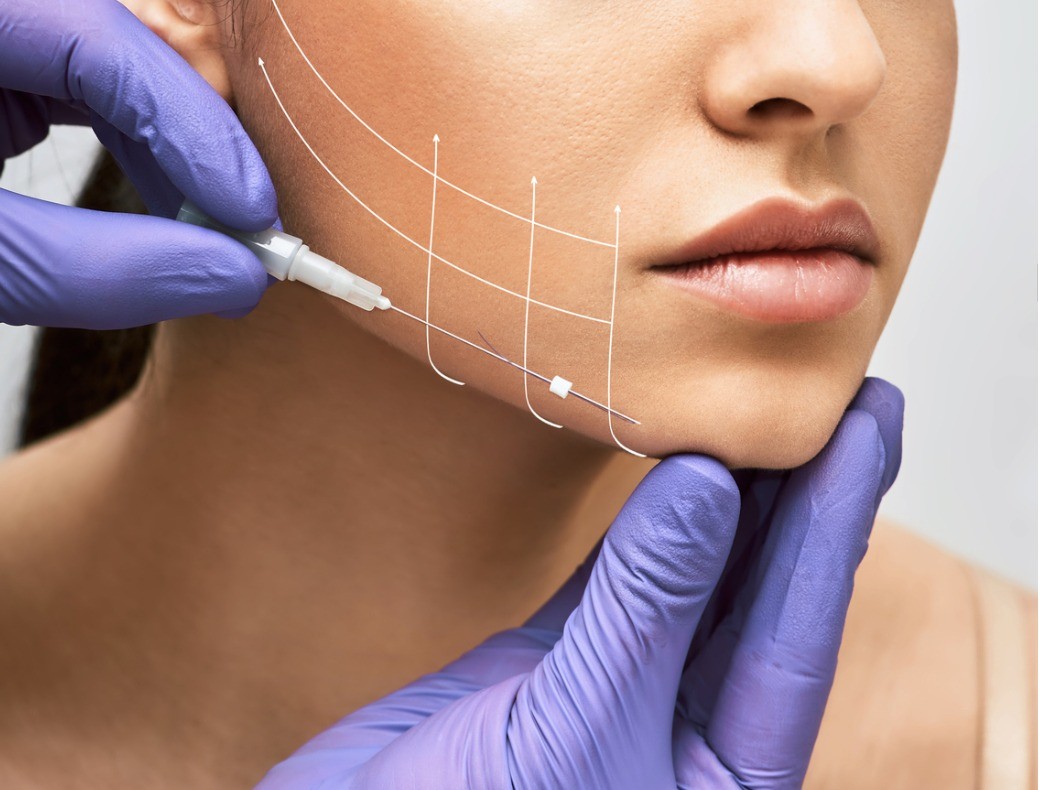 Thread Lifting - Allure Laser Skin and Aesthetic Medicine Centre