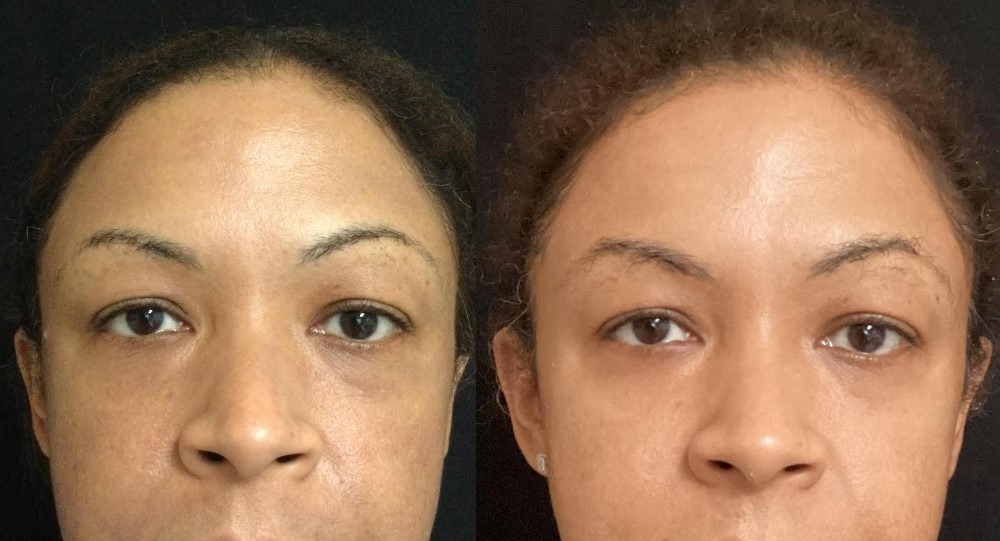 46-yo-female-before-after-Cosmelan-and-microneedling-w-depigment-MGWatermark