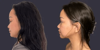 Chin-Liposuction-before-8327962-after-8327963-1-13884449