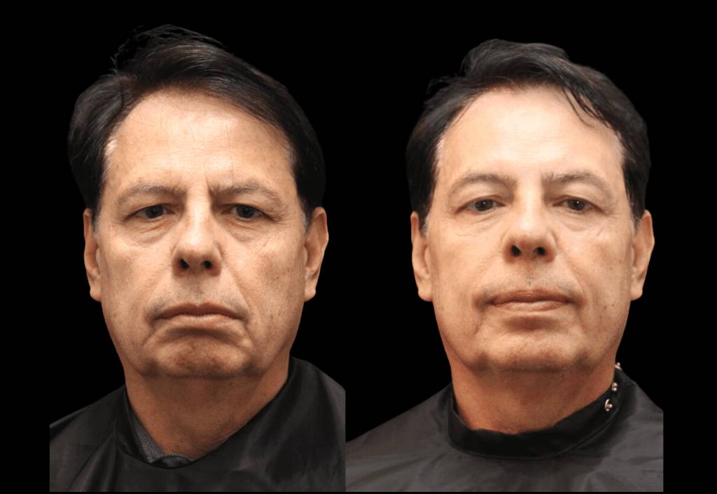 Exilis-Ultra-360???-Before-and-After-Photos-male Exilis-Ultra-360???-Before-and-After-Photos-male