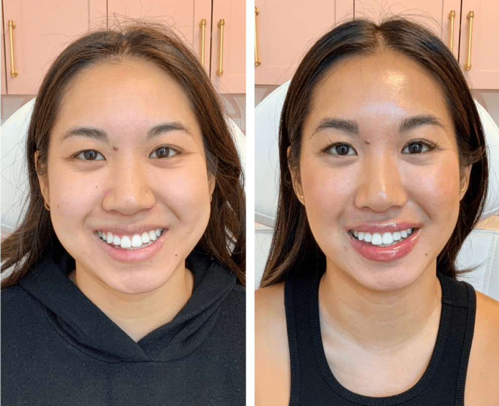 KN-masseter-1024x1024