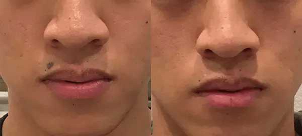 cosmetic-mole-removal-before-after