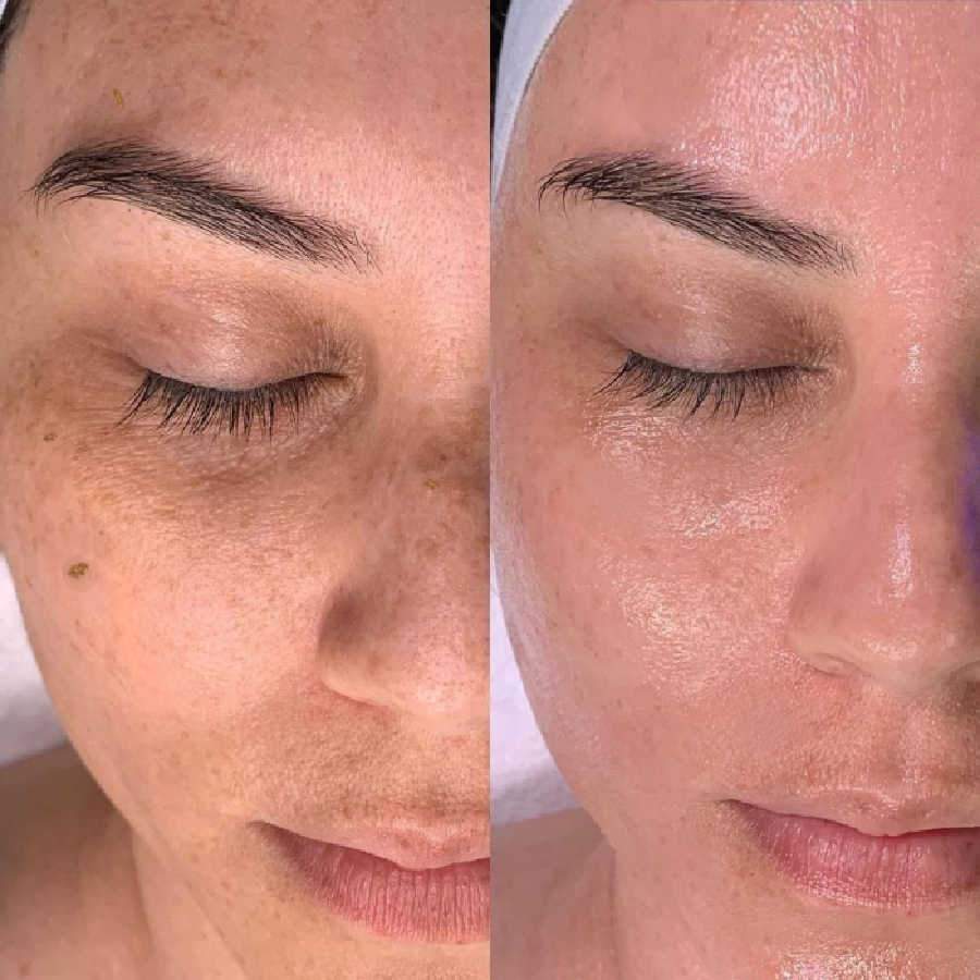 hydrafacial-before-and-after-treatment-burlington hydrafacial-before-and-after-treatment-burlington